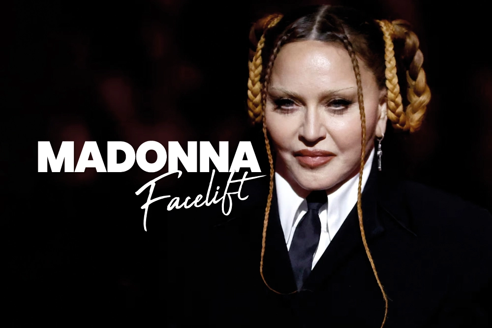 Madonna Facelift Before and After 2026 Update
