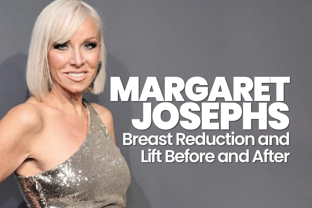 Margaret Josephs Breast Reduction and Lift Before and After 2026