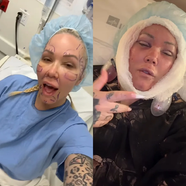 Why Bunnie Xo Joked She Looks Like Bert Kreischer Post-Surgery