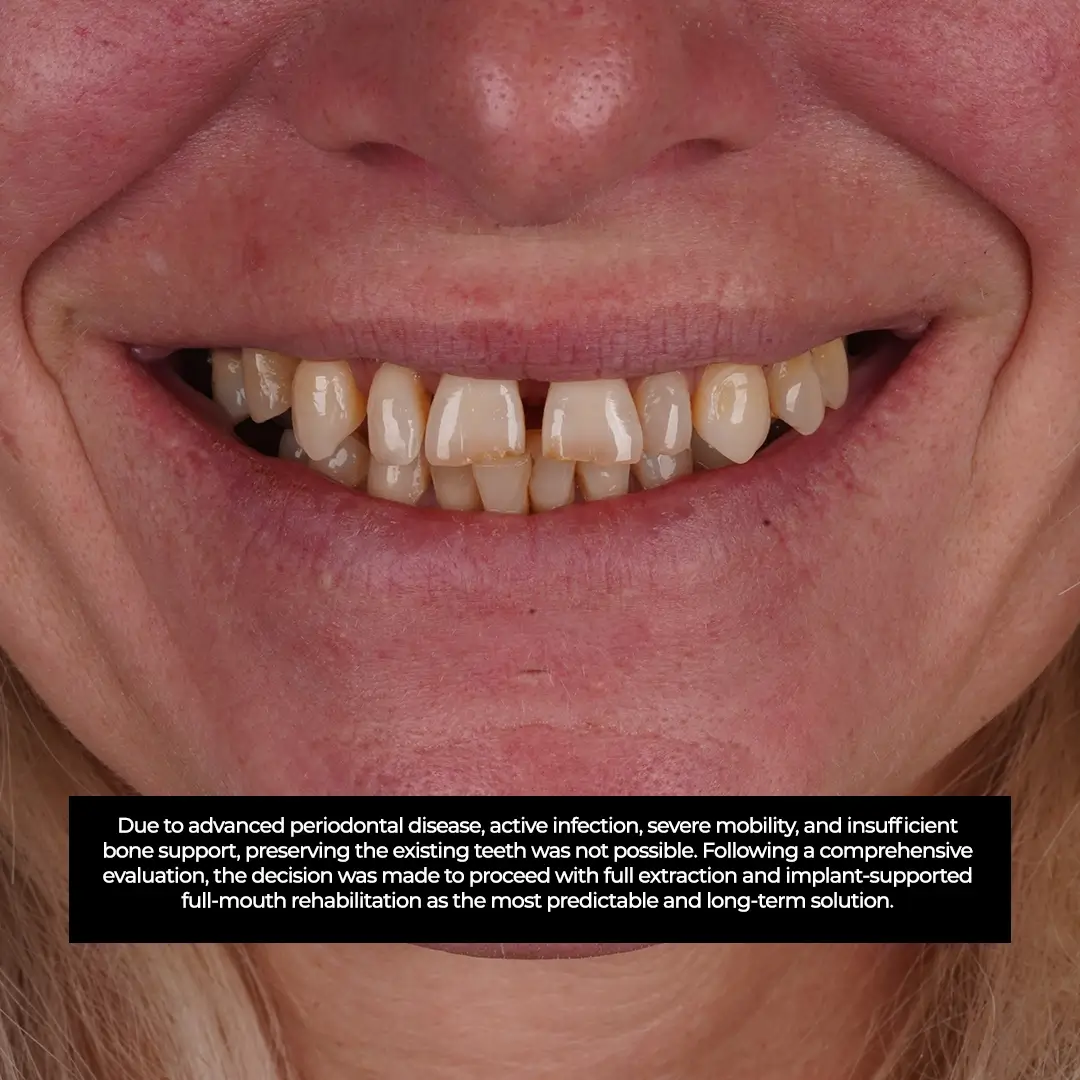 Advanced Bone Loss Meets Expert Care