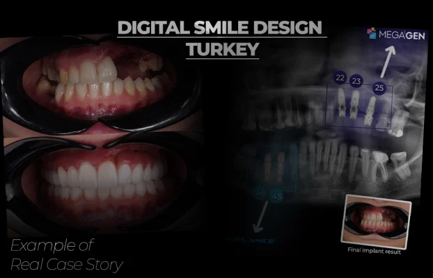 Advanced Full-Mouth Rehabilitation for Cleft Palate: Kasia Clinical Success Story