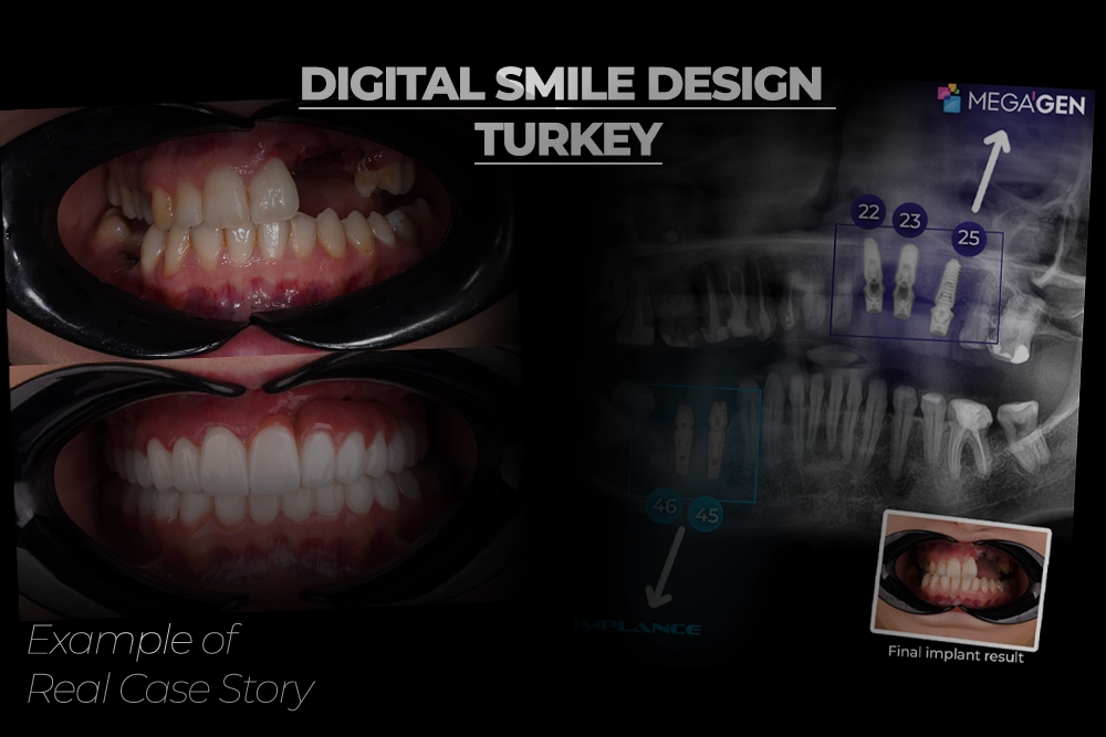 Advanced Full-Mouth Rehabilitation for Cleft Palate: Kasia Clinical Success Story