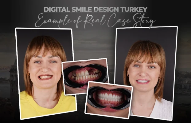 Advanced Full-Mouth Rehabilitation for Cleft Palate: Klasia’s Clinical Success Story