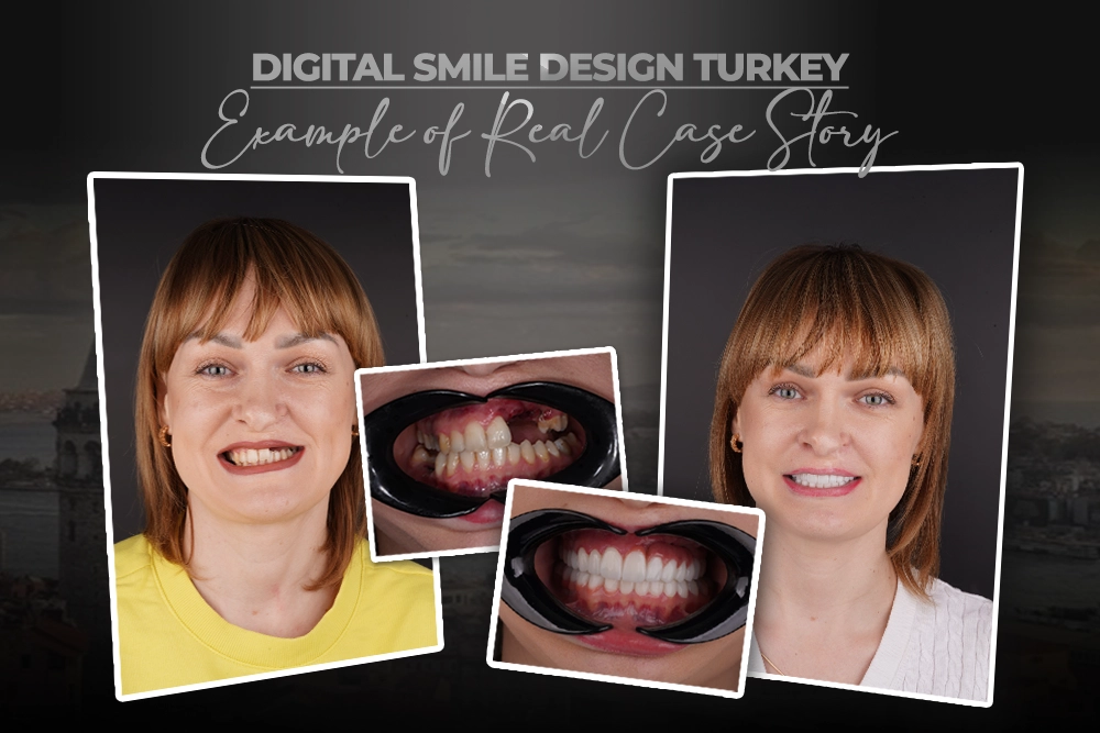 Advanced Full-Mouth Rehabilitation for Cleft Palate: Klasia’s Clinical Success Story