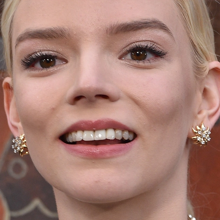 Anya Taylor-Joy Dental Work Expert Analysis 2026