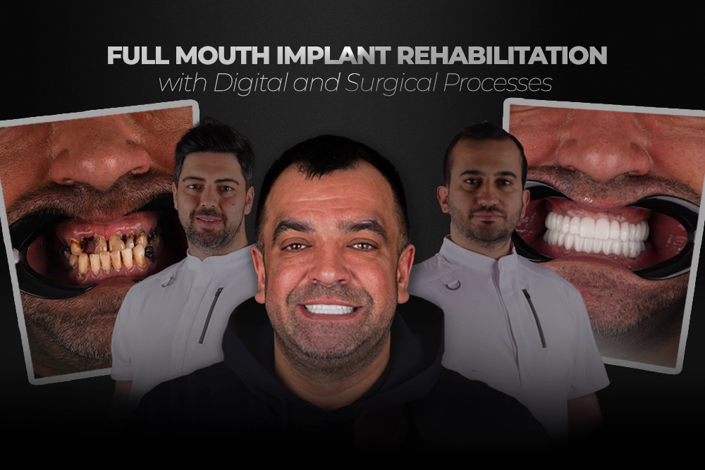 Complete Digital Full Mouth Implant Rehabilitation in Istanbul