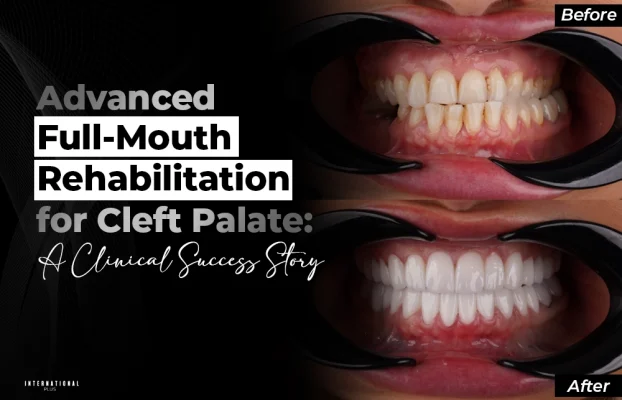 Crossbite Correction & Dental Implants: A Zirconium Case