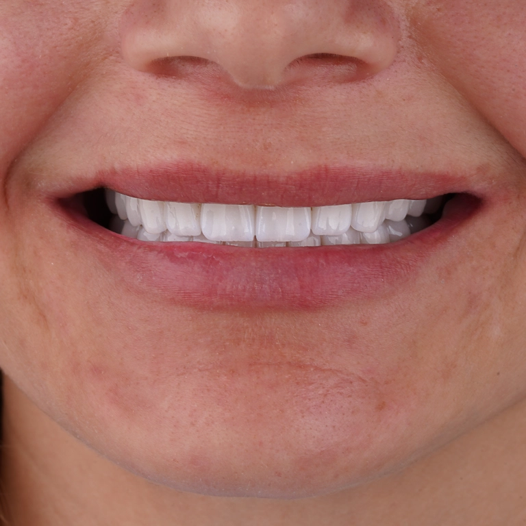Digital Dentistry From Temporary Teeth to Final Restoration