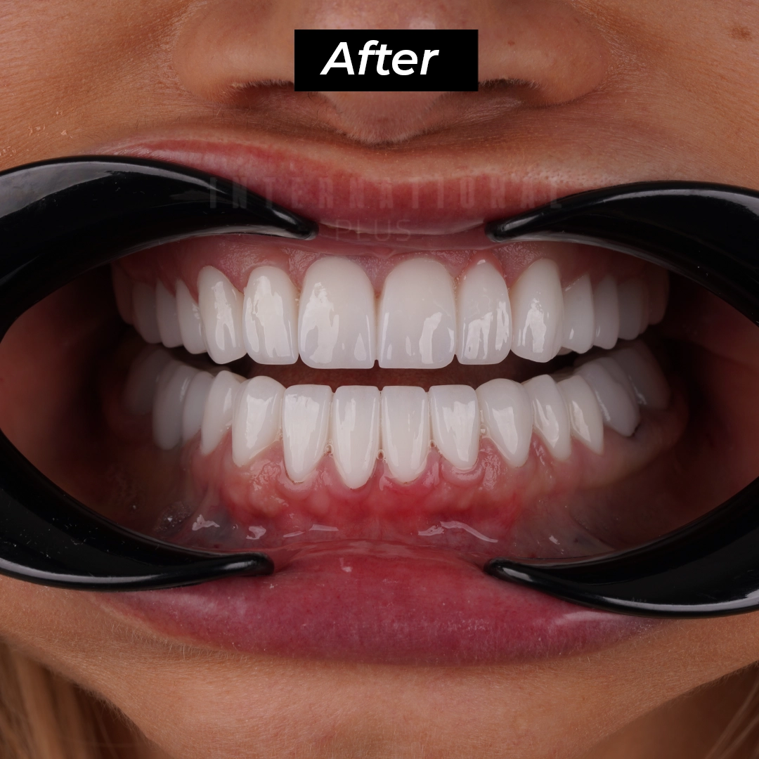 Digital Face Scanning and Smile Design