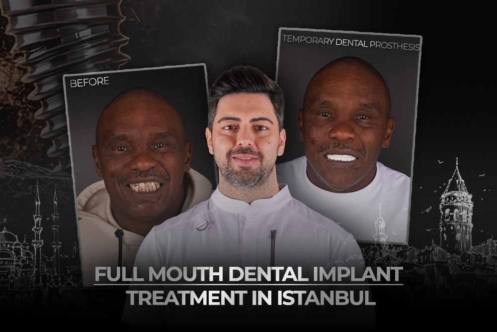 Full Mouth Dental Implant Treatment in Istanbul