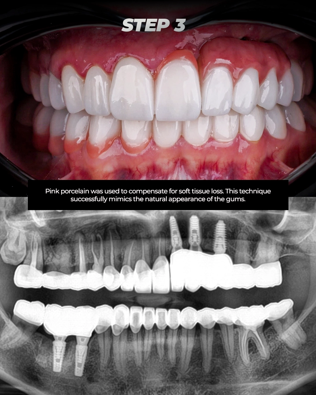 Full Mouth Reconstruction Results From Poland to Turkey