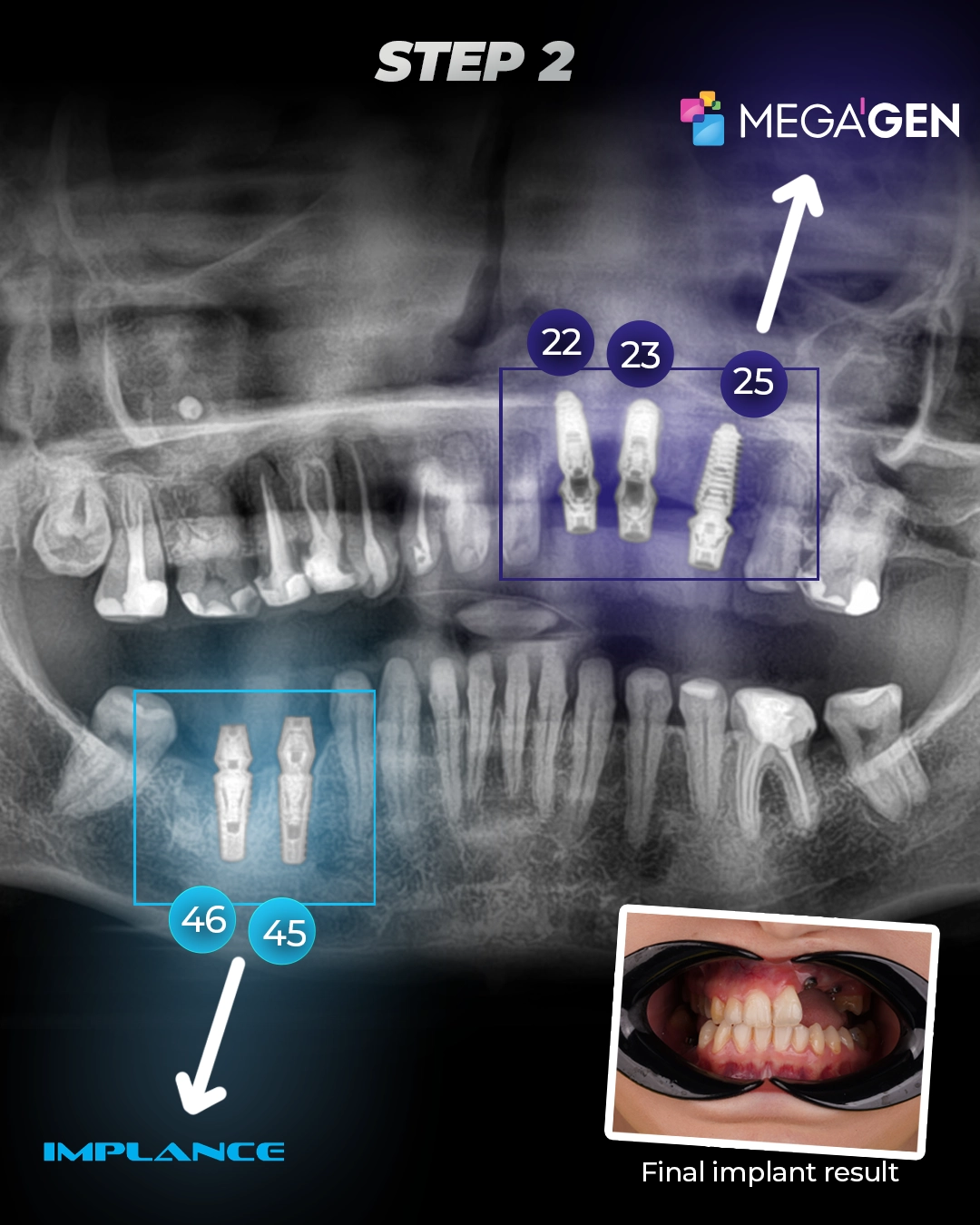 Mastering Aesthetics with Pink Porcelain and Zirconium