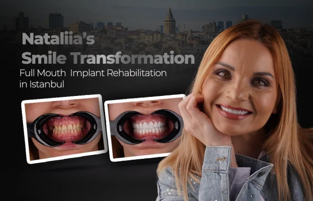 Nataliia’s Smile Transformation: Full-Mouth Implant Rehabilitation in Istanbul