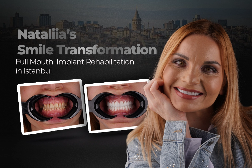 Nataliia’s Smile Transformation: Full-Mouth Implant Rehabilitation in Istanbul