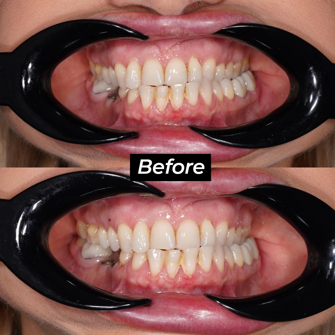 Overcoming Crossbite and Dental Infections