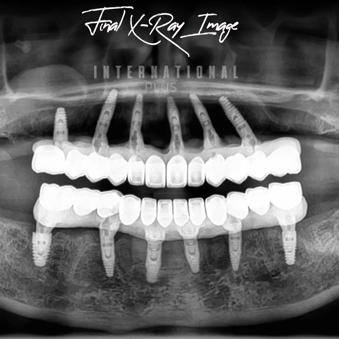 Prosthetic Phase Digital Smile Design Process