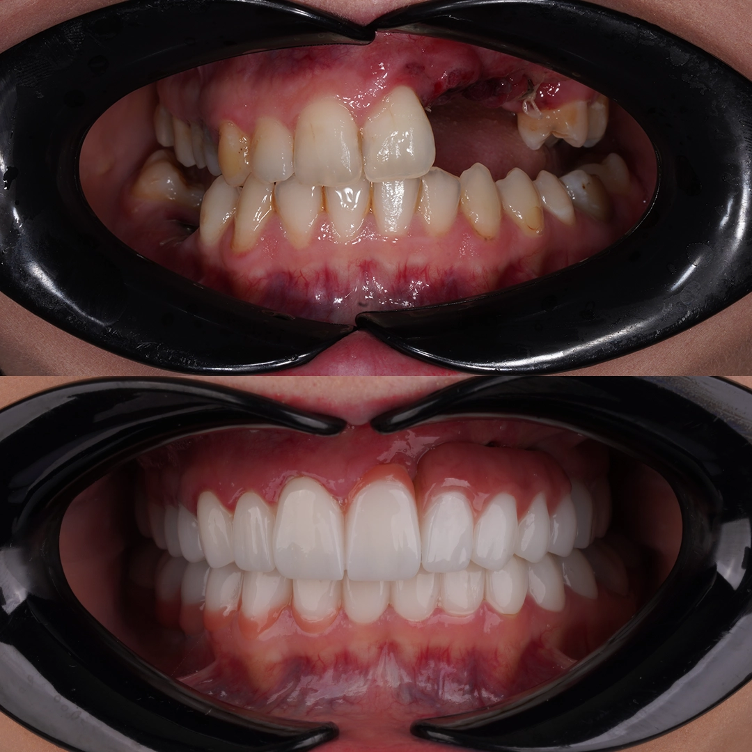 Restoring Smiles After Cleft Palate Complications