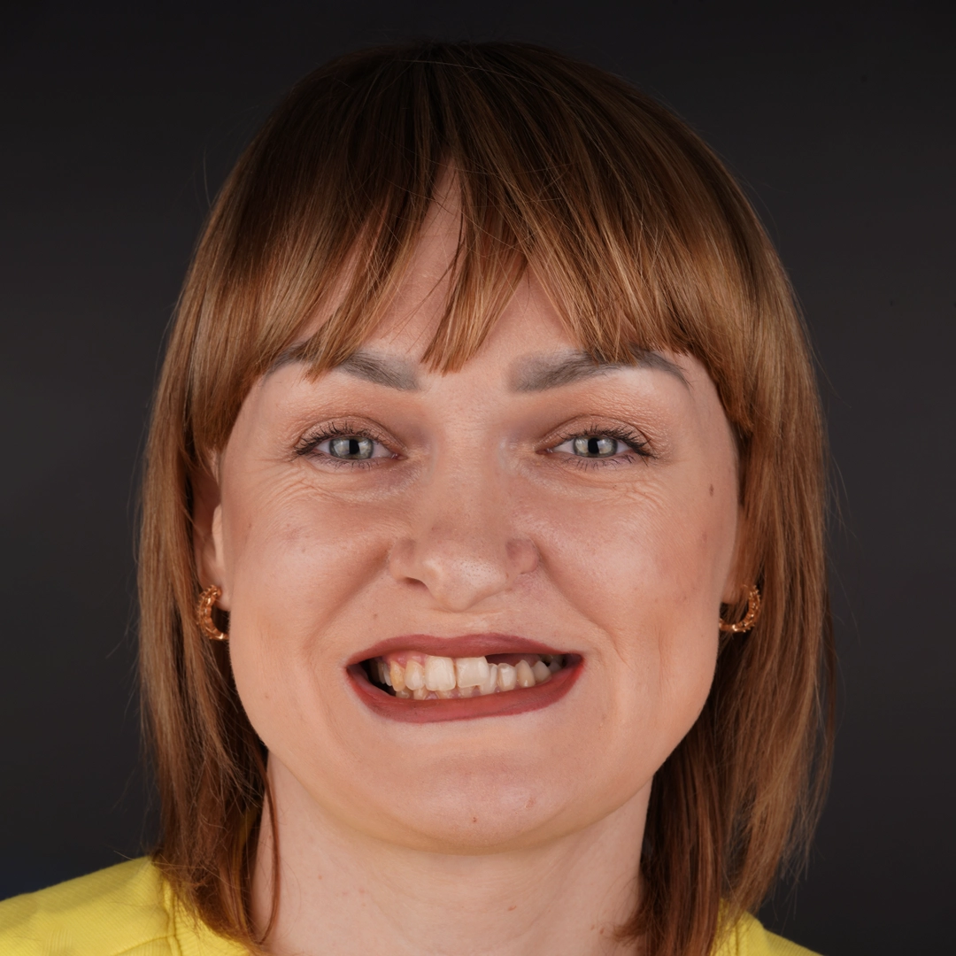 Restoring Smiles After Cleft Palate Complications