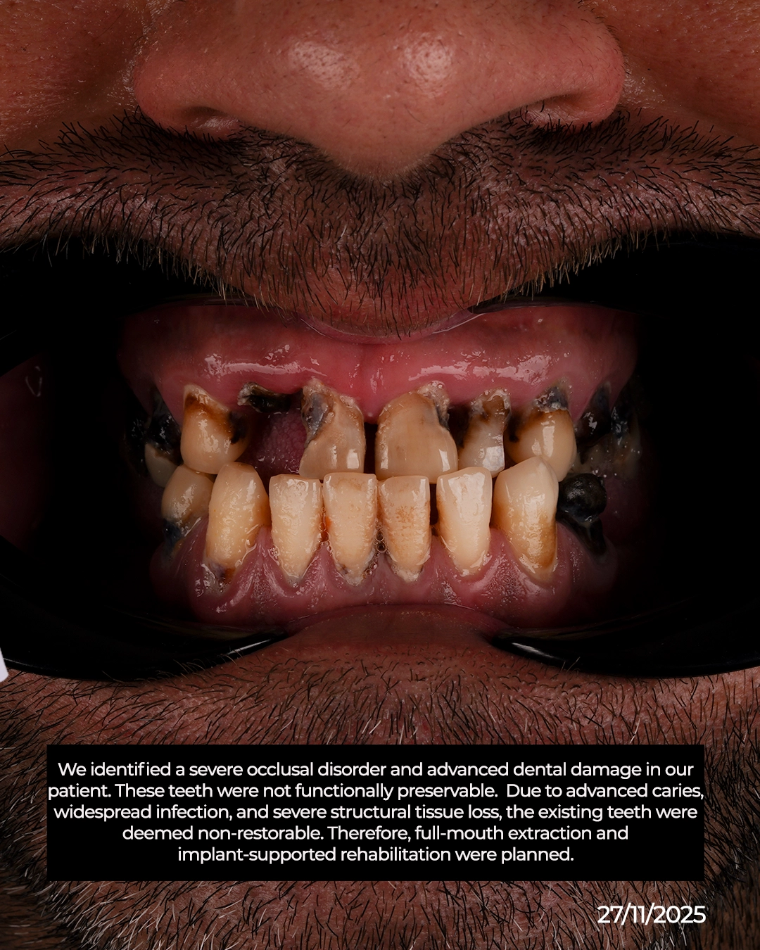 Same Day Temporary Teeth and Patient Comfort