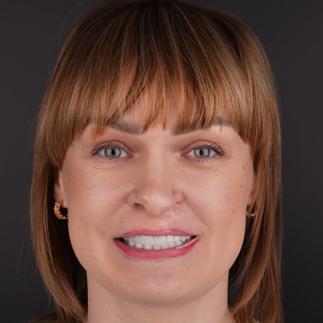 Strategic Extraction and Implant Placement with Megagen and Implance