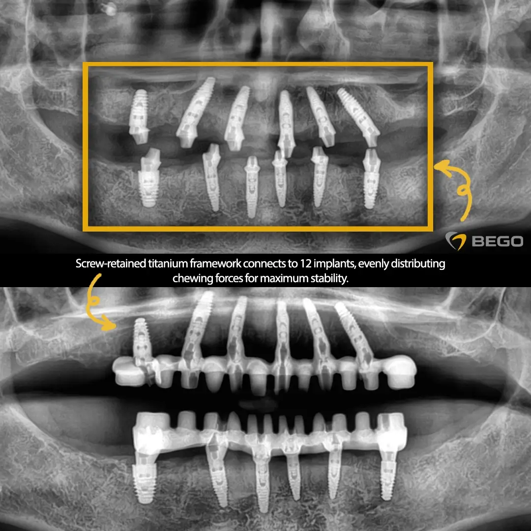 Surgical Phase Twelve Implant Rehabilitation