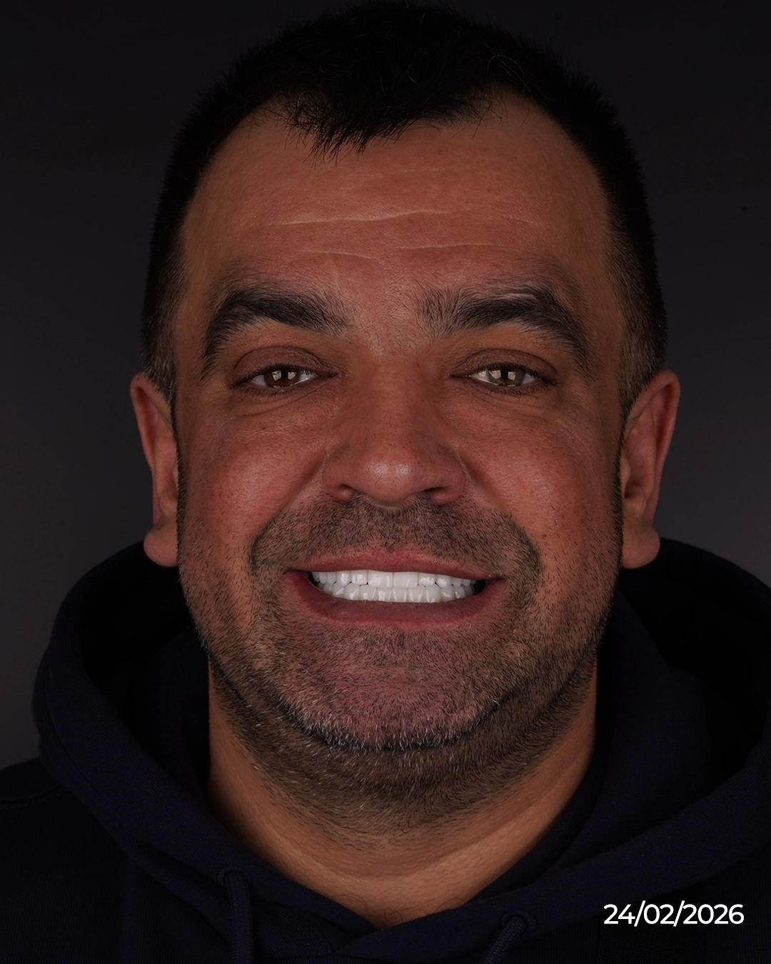 Surgical Phase with Advanced Implant Systems