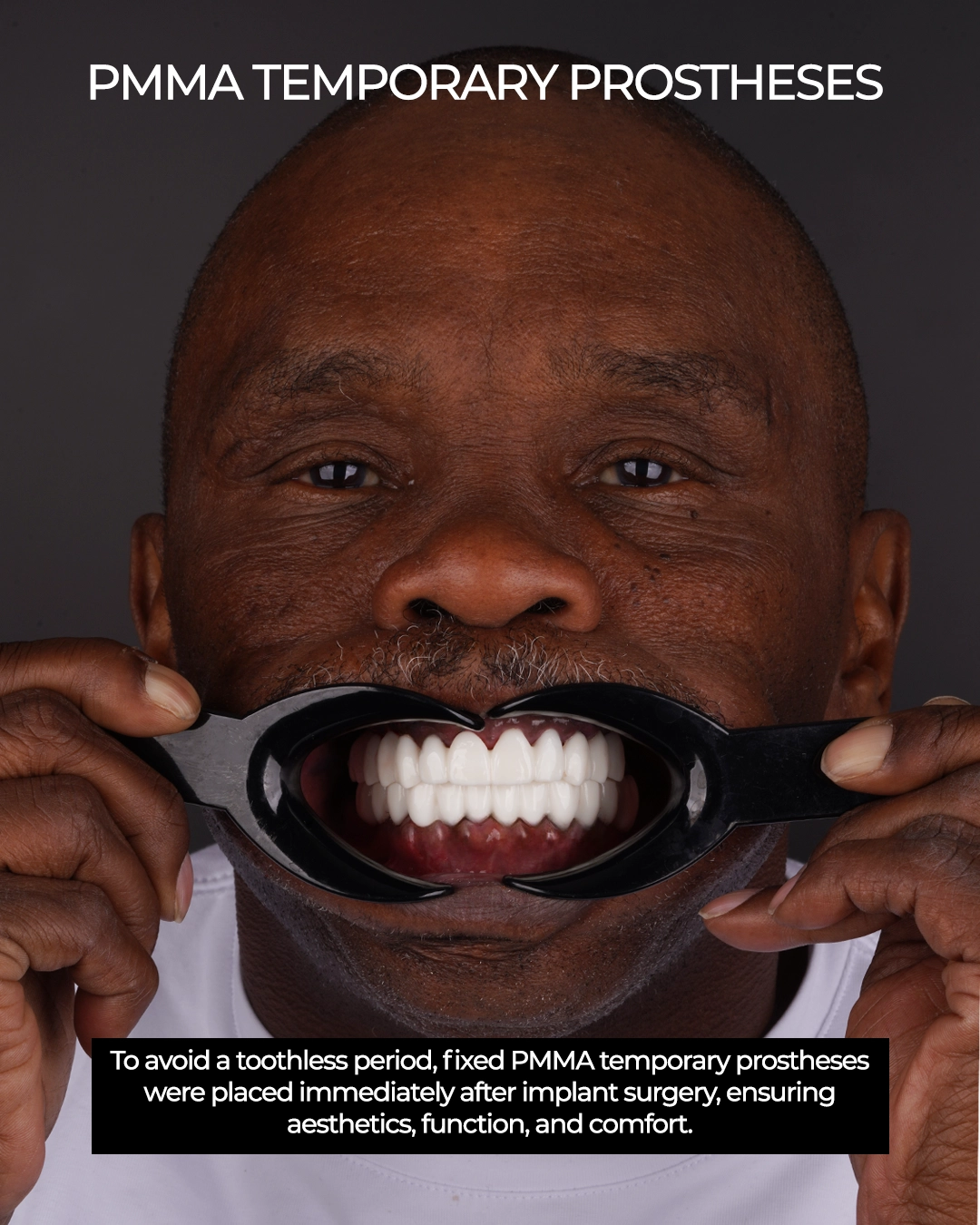 Understanding Advanced Tooth Loss and Treatment Options