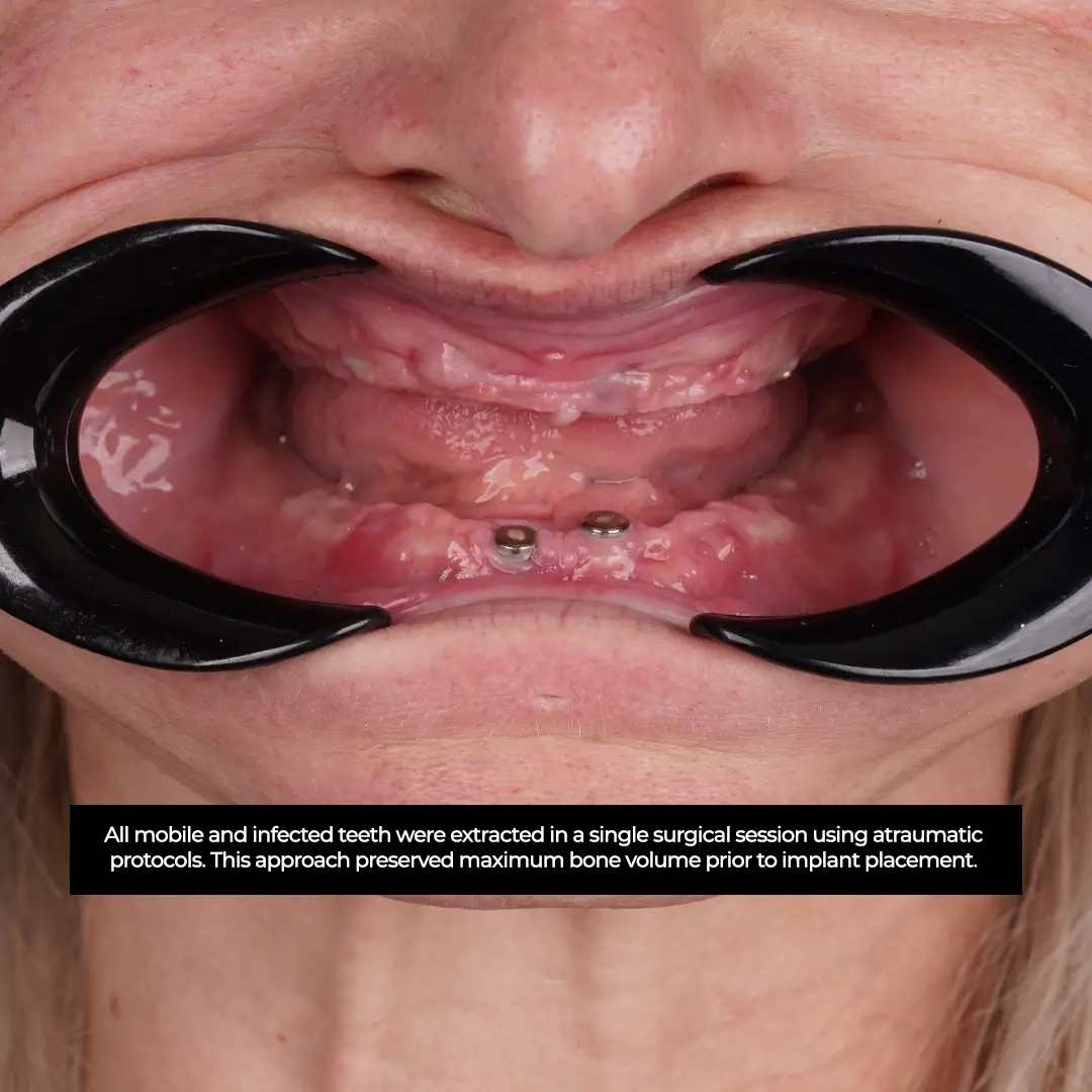Understanding Prognosis in Complex Dental Cases
