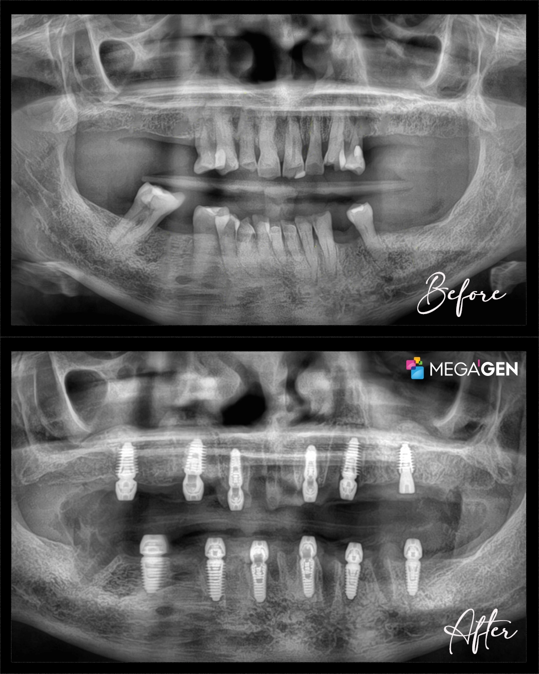 What is Sinus Lifting and How Does It Work