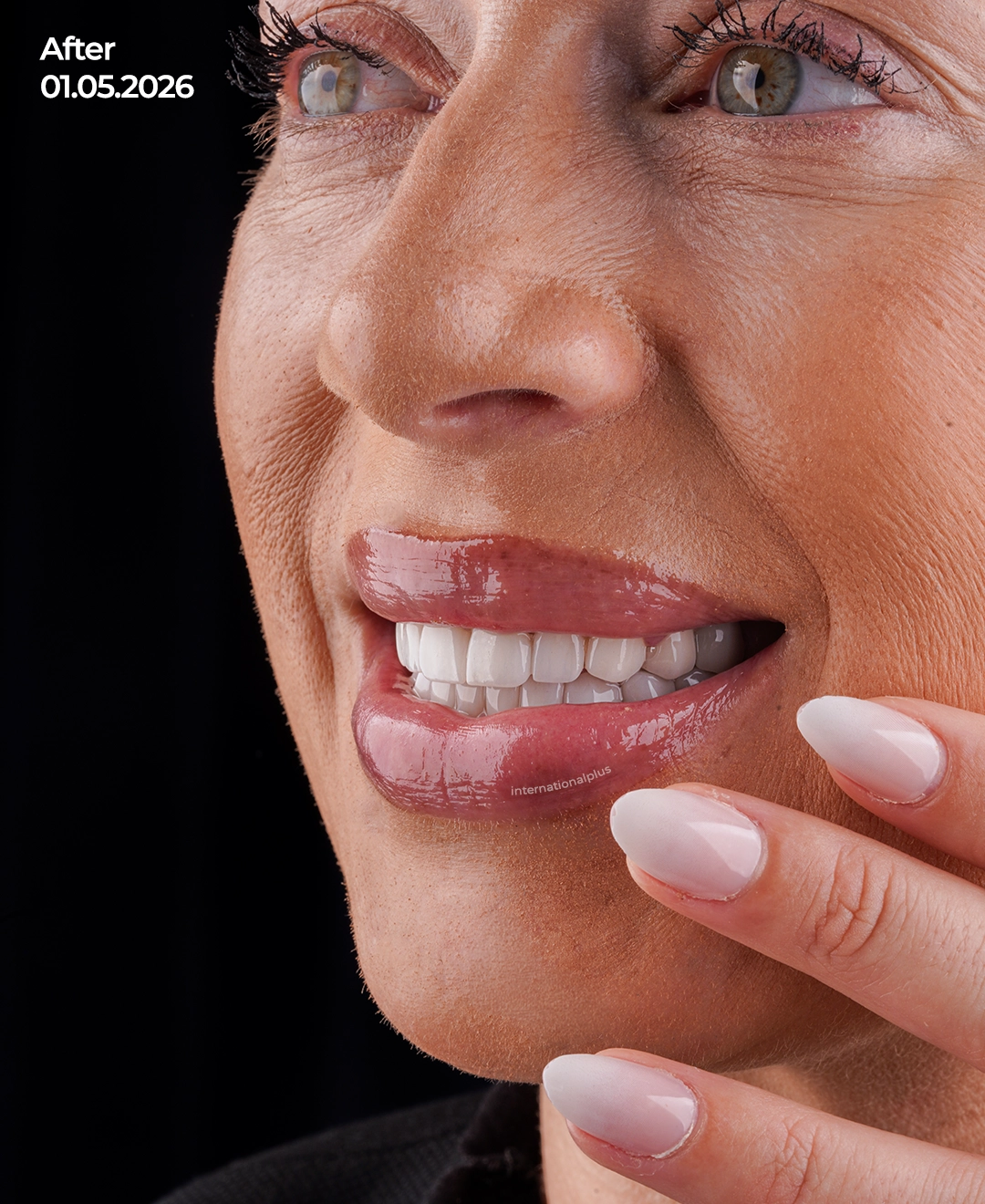 Advanced Prosthodontic Phase Achieving the Brightest White Aesthetic