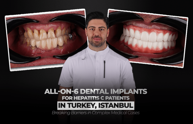 All-on-6 Dental Implants for Hepatitis C Patients in Turkey, Istanbul: Breaking Barriers in Complex Medical Cases