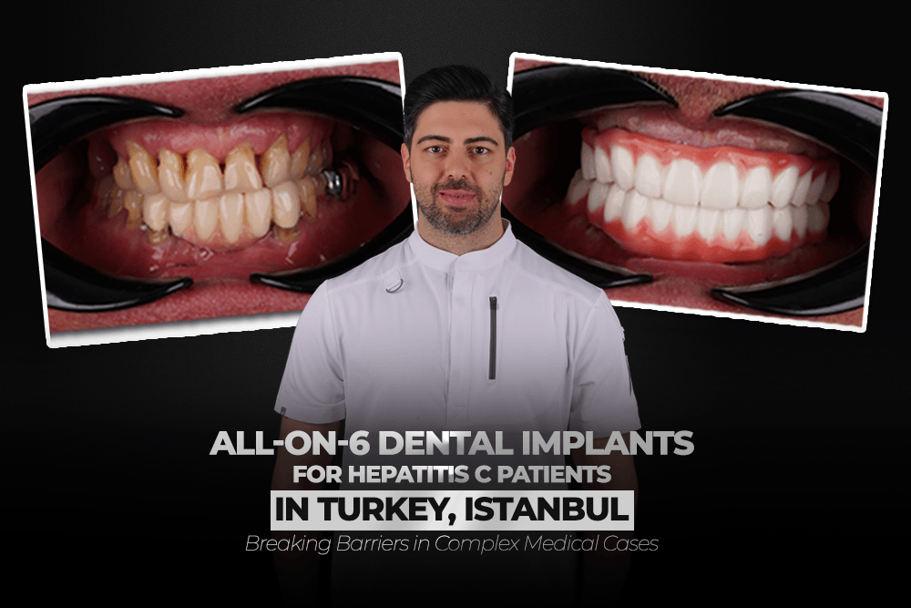 All-on-6 Dental Implants for Hepatitis C Patients in Turkey, Istanbul: Breaking Barriers in Complex Medical Cases