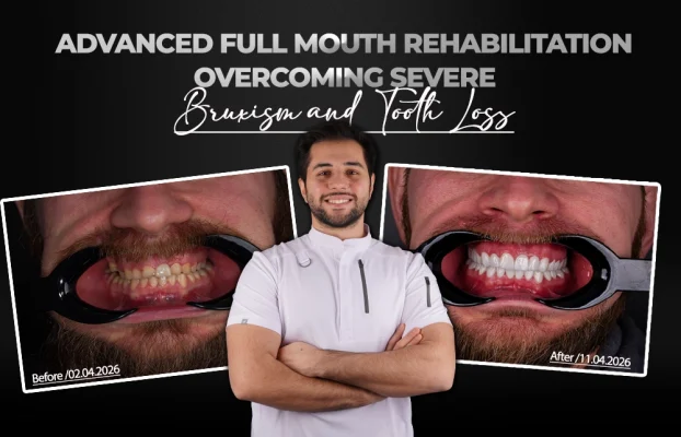 Bohdan: Advanced Full Mouth Rehabilitation Overcoming Severe Bruxism and Tooth Loss