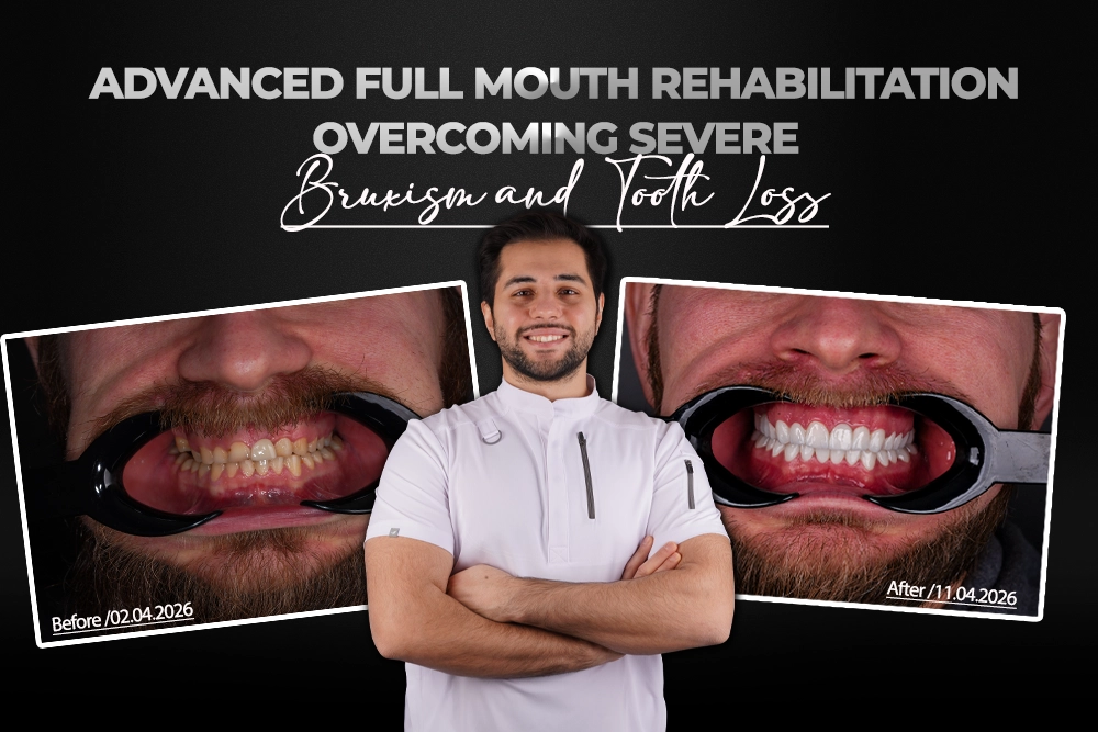 Bohdan: Advanced Full Mouth Rehabilitation Overcoming Severe Bruxism and Tooth Loss