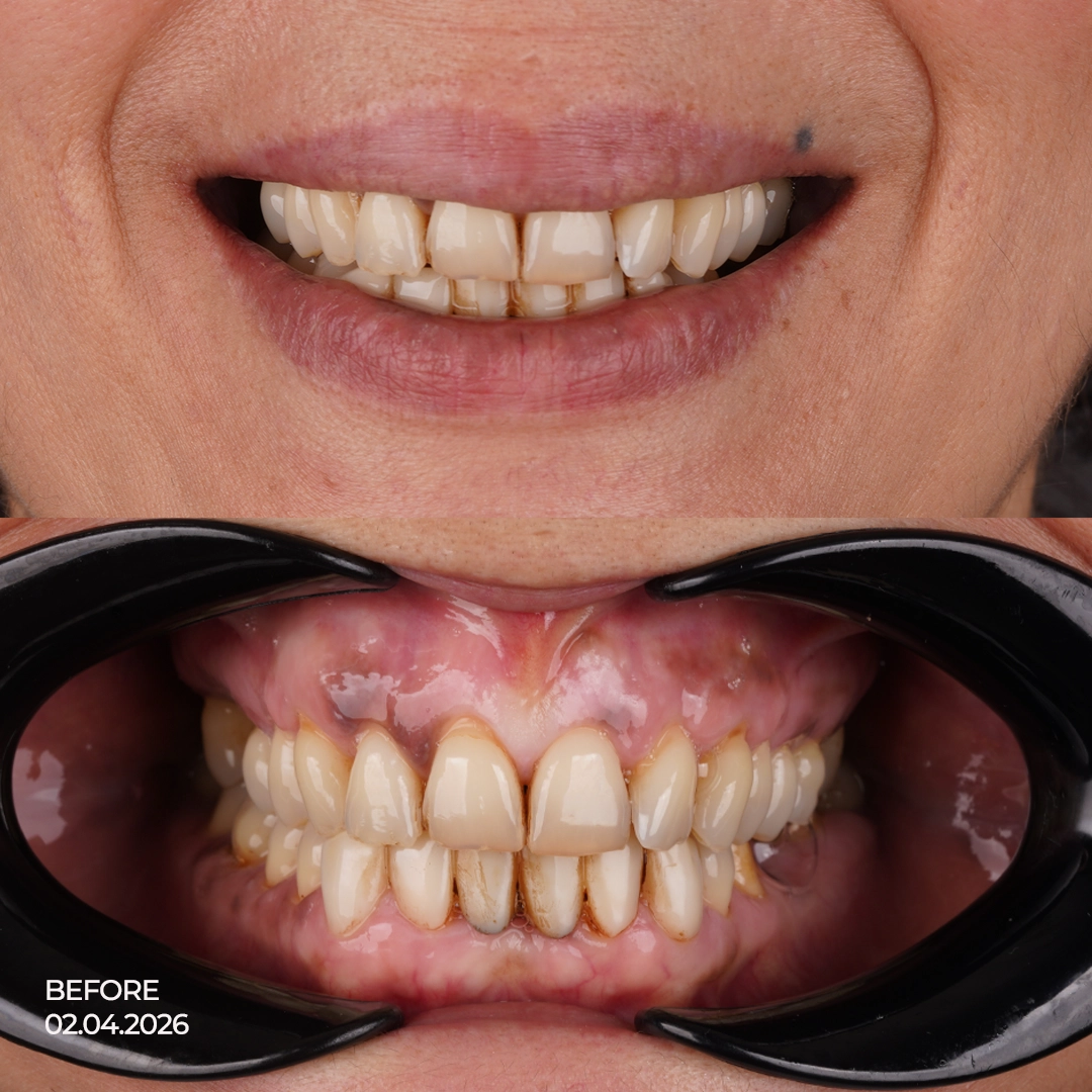 Comprehensive Dental Assessment and Treatment Planning at International Plus Istanbul