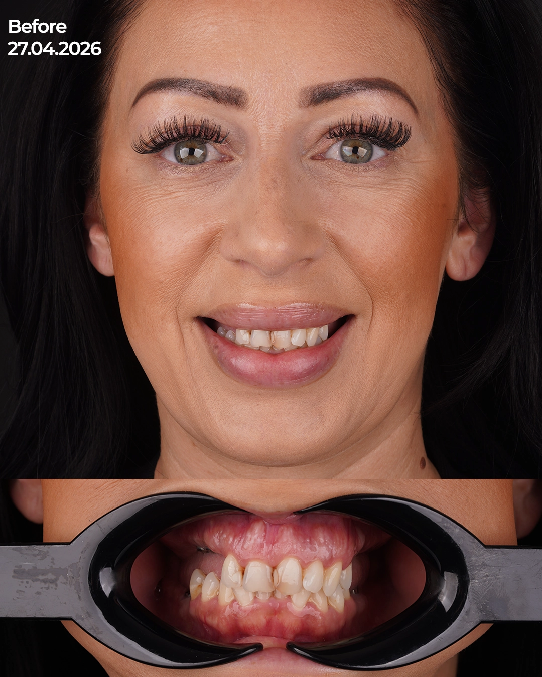 Comprehensive Surgical Phase Integrating Extraction, Augmentation, and Implant Placement