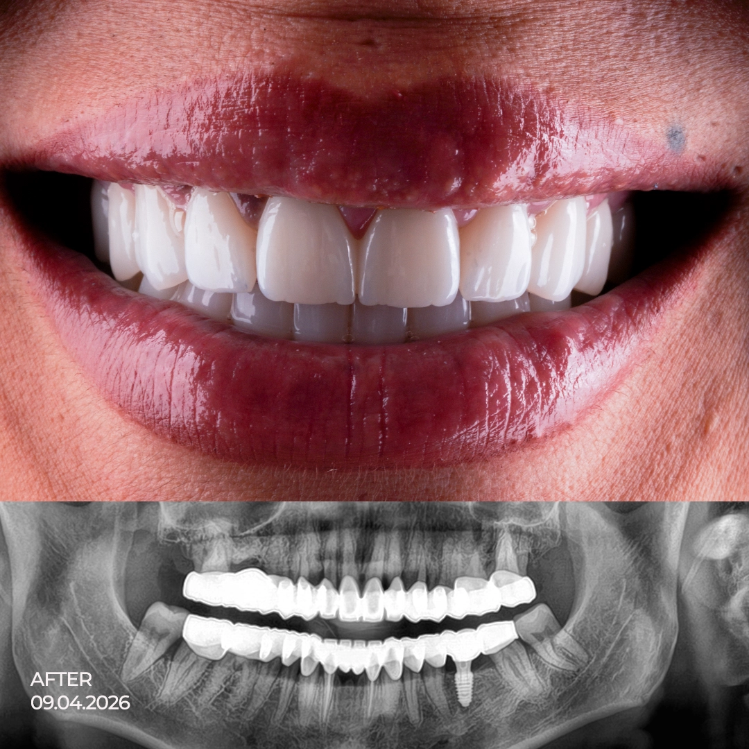 Digital Smile Design and Aesthetic Planning