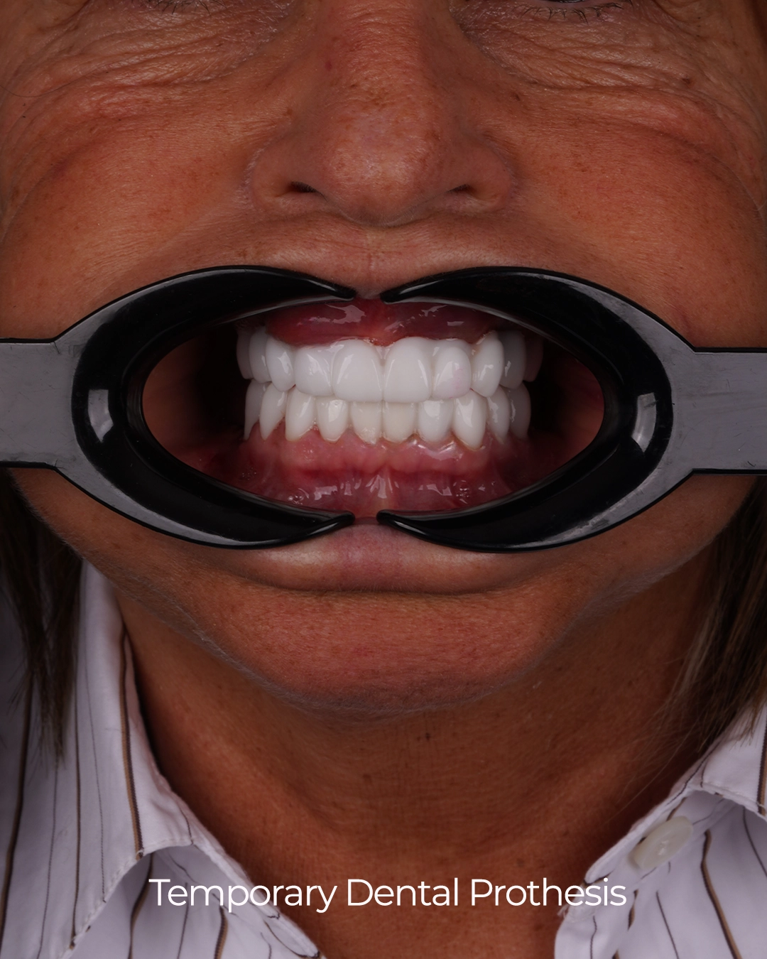 Digital Smile Design with Advanced Technology by Dr. Şehrazat