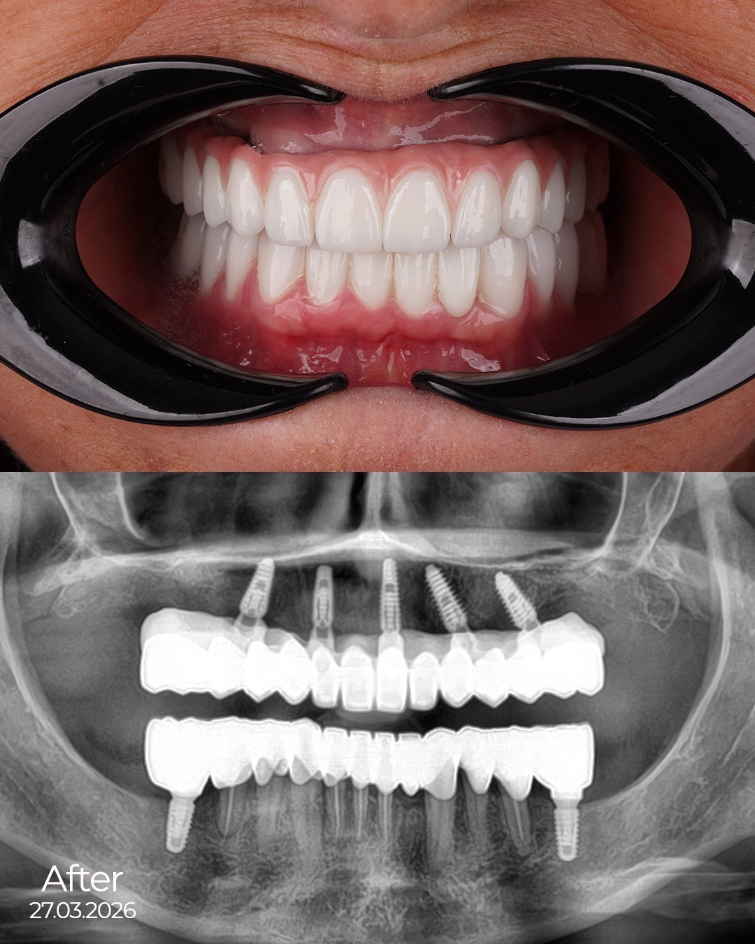 Digital Smile Design with Advanced Technology by Dr. Şehrazat