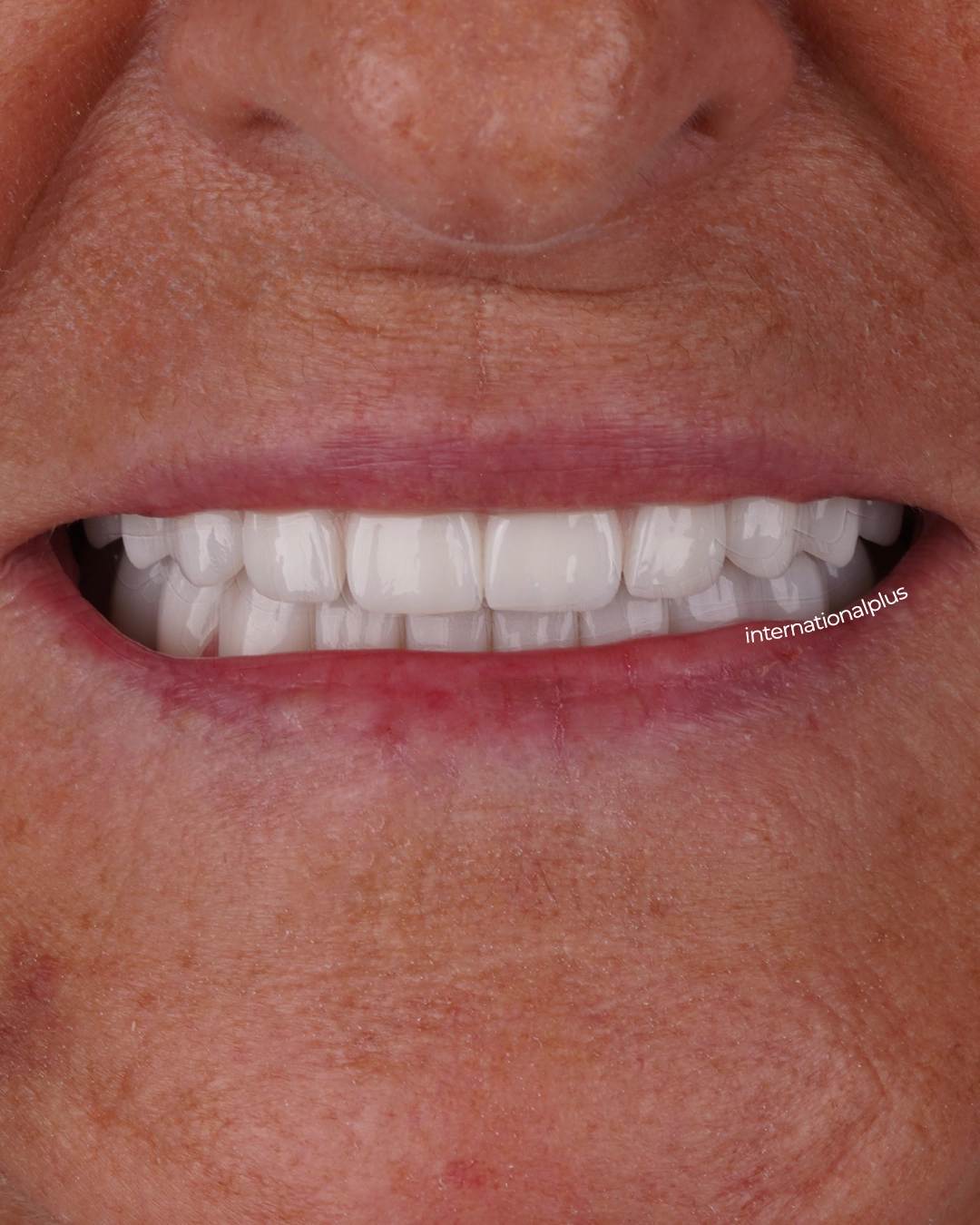Final Zirconia Restorations and Long-Term Success