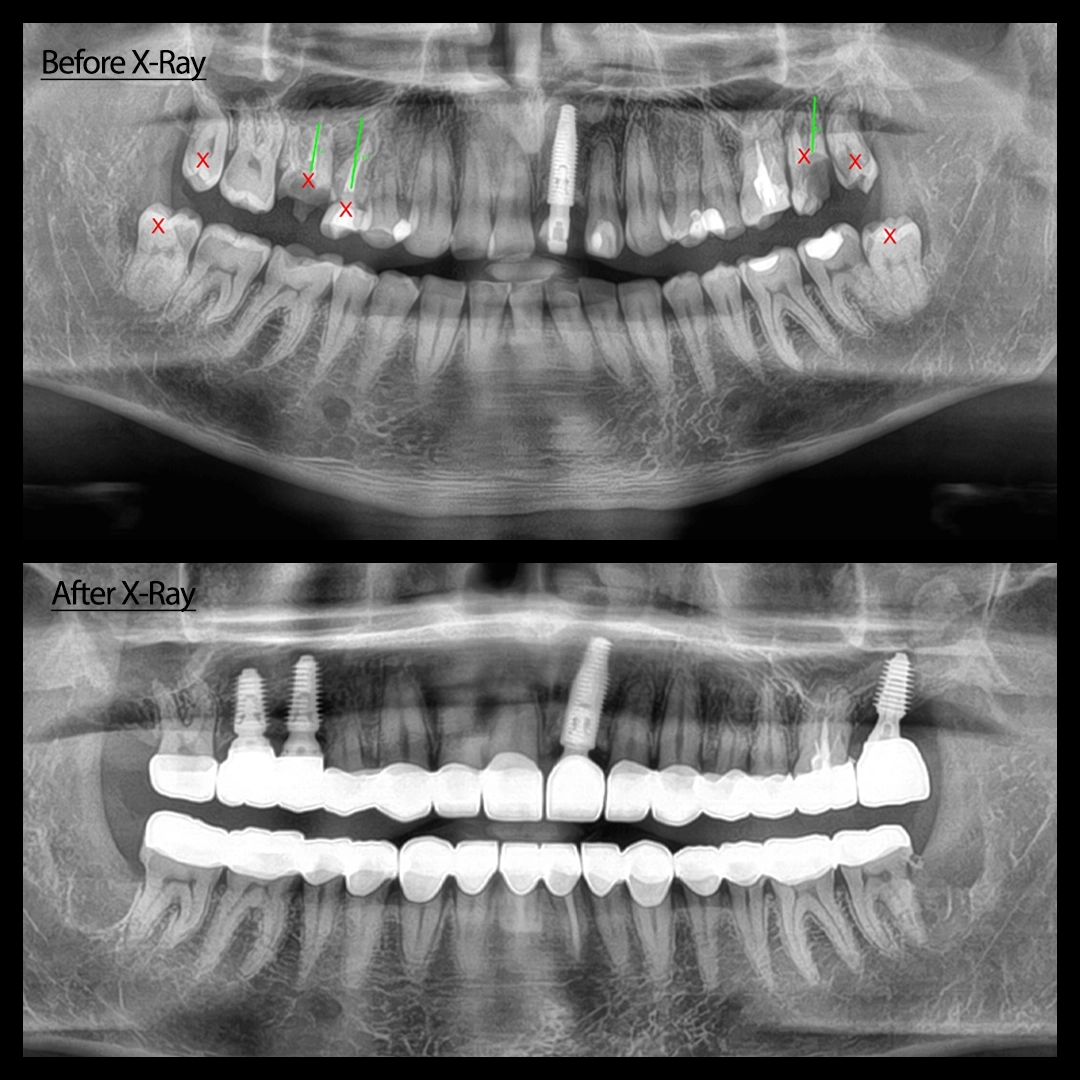 Gingivectomy for Anterior Aesthetic Balance