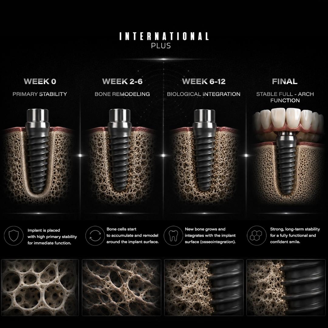How Tilted Implants Achieve Stability Biomechanical Analysis