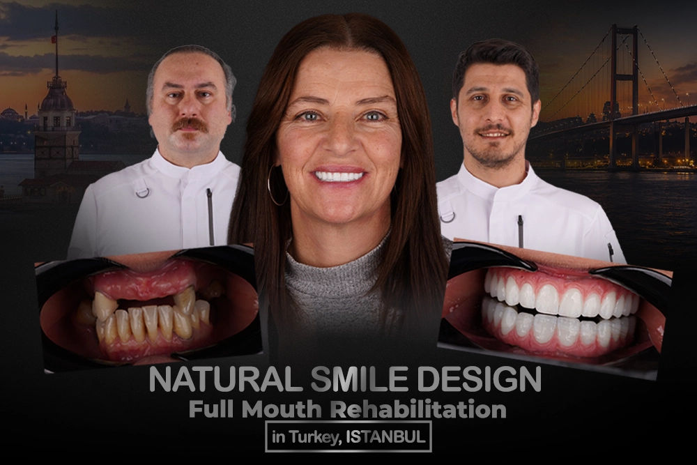 Natural Smile Design with Full Mouth Rehabilitation in Turkey, Istanbul