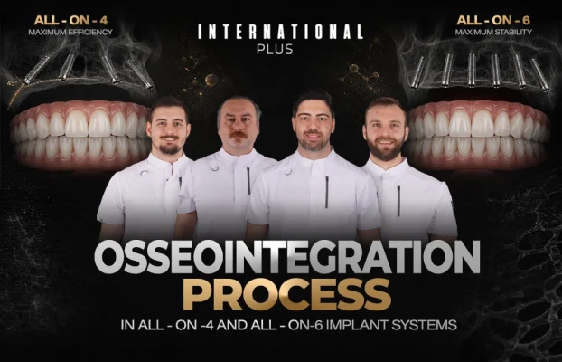 Osseointegration Process in All-on-4 and All-on-6 Implant Systems