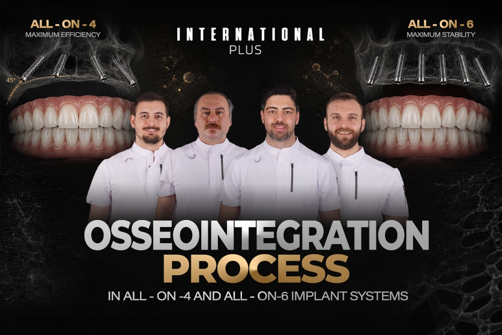 Osseointegration Process in All-on-4 and All-on-6 Implant Systems