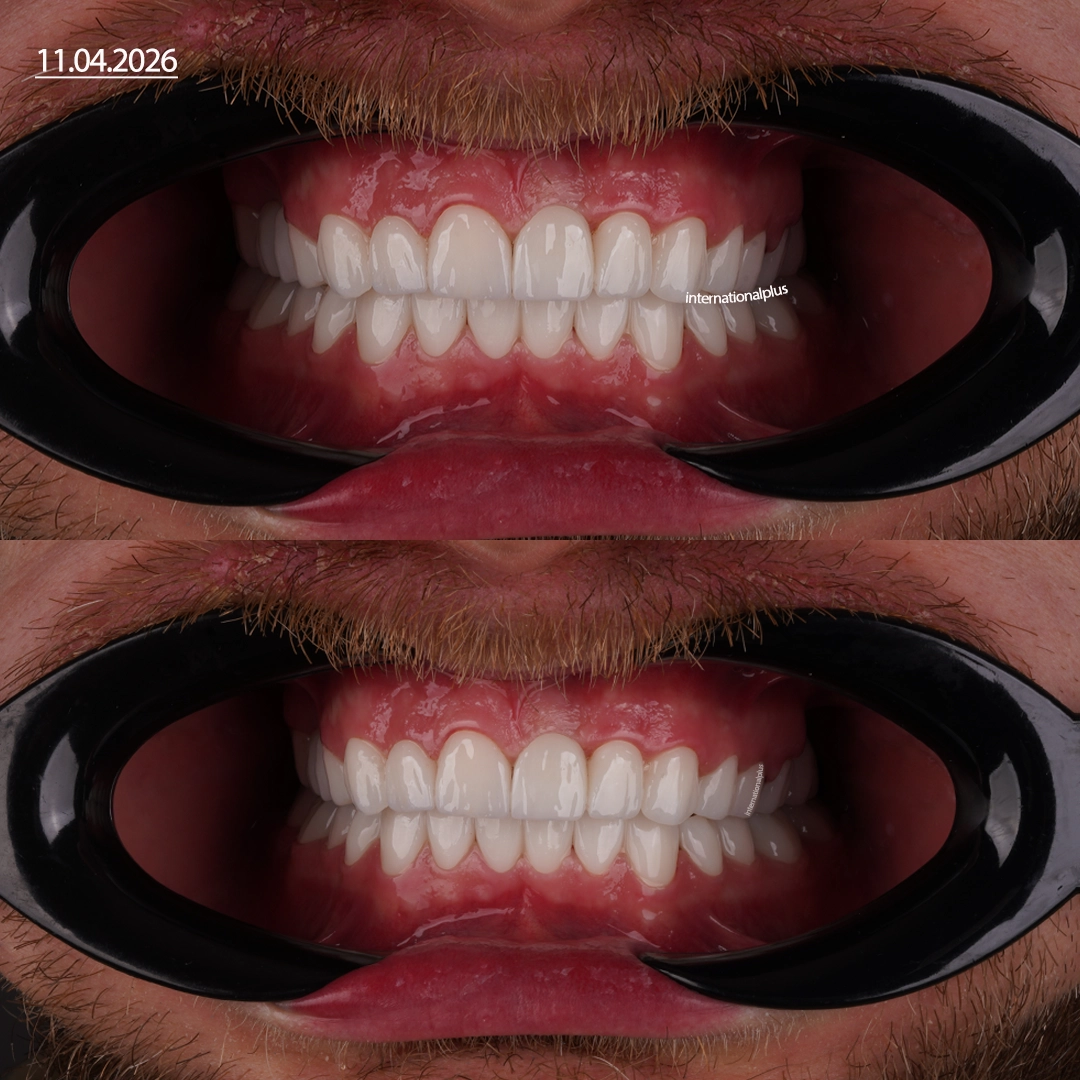 Restoring Vertical Dimension of Occlusion