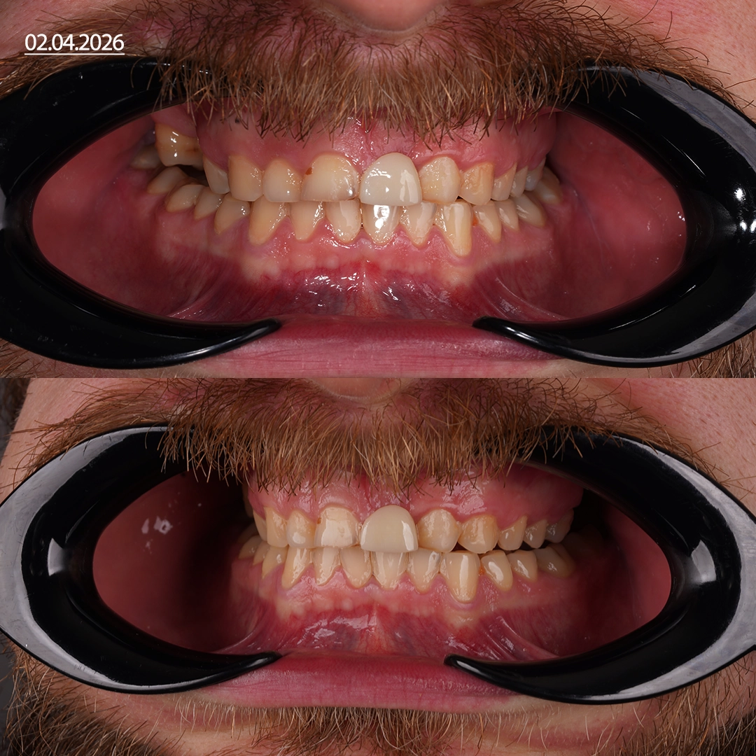 Treating Severe Bruxism and Tooth Wear