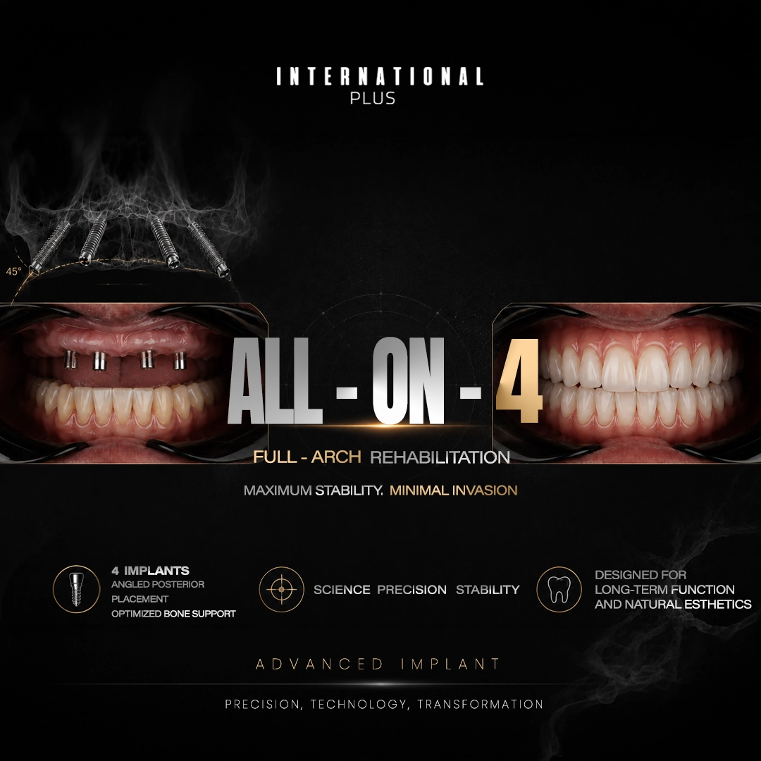 What Is Osseointegration and Why Does It Matter for Full-Arch Implants
