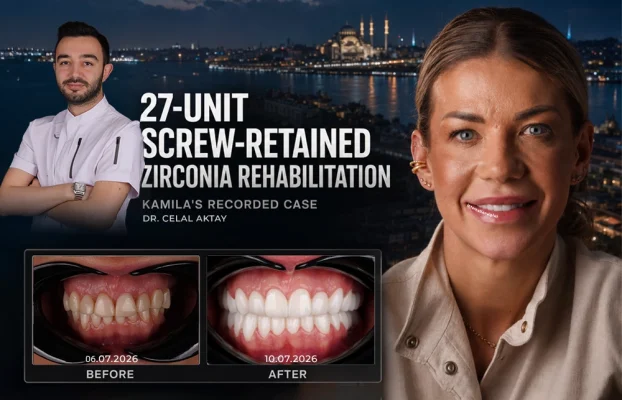 A 27 Unit Screw Retained Zirconia Rehabilitation: Kamila’s Recorded Case