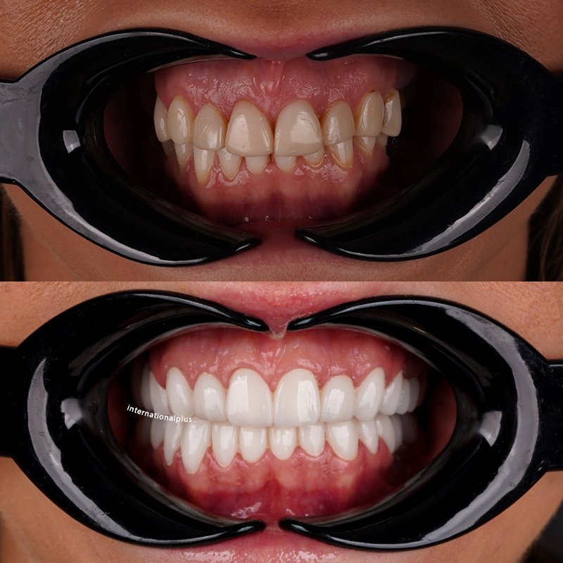 How Were the Impressions Taken and the Zirconia Built